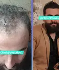 کاشت مو و ابرو بدون کوتای و جراحی